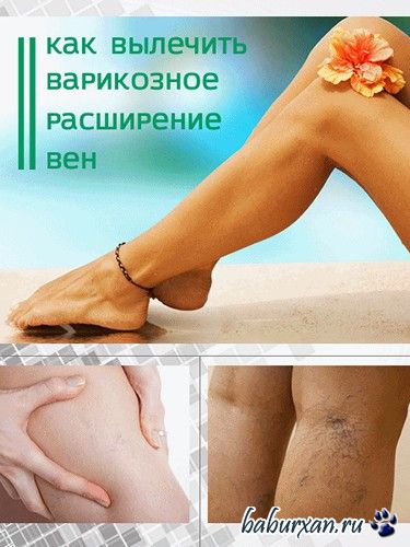 Как вылечить варикоз дома (2016)